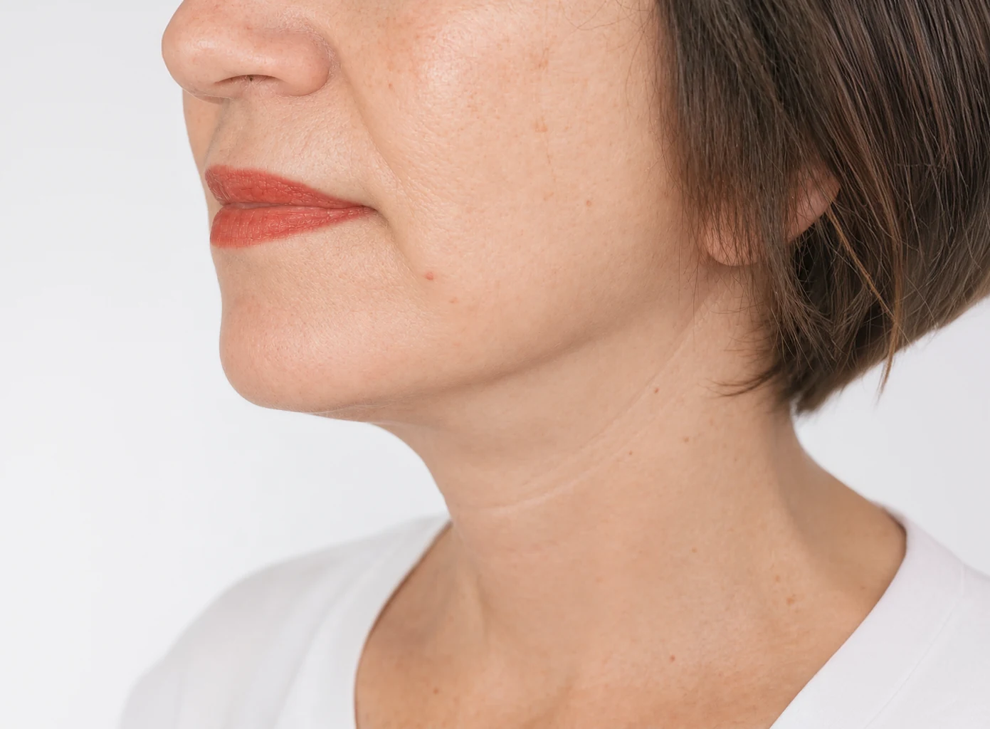 Patient after lower-face and neck treatment