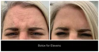 BOTOX® and Dysport® Treatments in London Ontario before and after result