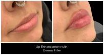 Dermal Filler in London Ontario before and after result