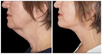 Before and after neck lift at Yazdani Aesthetics in London Ontario, showing a smoother jawline and tightened neck skin with a light complexion and brown hair.