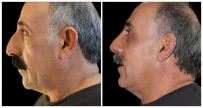 Rhinoplasty in London Ontario before and after result