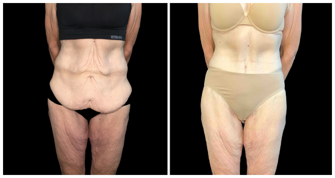 360° Contouring - Body Contouring in London Ontario before and after result