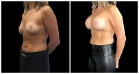 Breast Augmentation in London Ontario before and after result