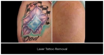 Laser Tattoo Removal in London Ontario before and after result