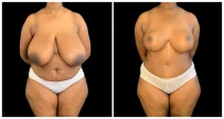 Breast Reduction before and after result