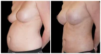 Fat Transfer to Breast before and after result