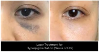 Laser Treatments for Pigmentation before and after result