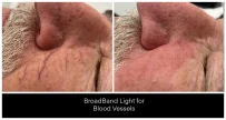 Laser Treatments for Redness before and after result