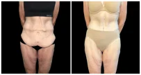 360° Contouring - Body Contouring in London Ontario before and after result
