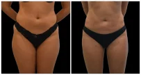 Before and after images of a liposuction procedure showing changes in abdominal contour and skin appearance.