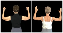 Arm Lift in London Ontario before and after result