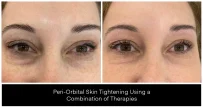 Before and after images of peri-orbital skin tightening treatment showing improved appearance around the eyes.