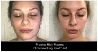 Microneedling London Ontario before and after result