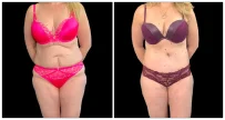 Fat Transfer to Body before and after result