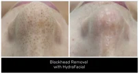 Hydrafacials London Ontario before and after result