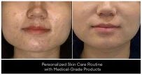 At-Home Skin Care before and after result