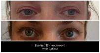 Eyelash Enhancement with LATISSE® before and after result