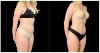 EMSCULPT® in London Ontario before and after result