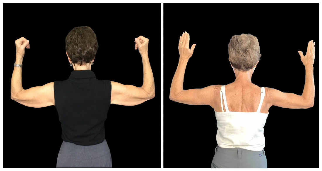 Arm Lift in London Ontario before and after result