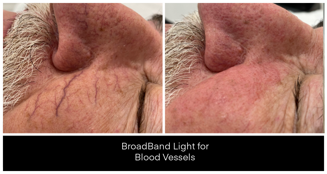 Laser Treatments for Redness before and after result