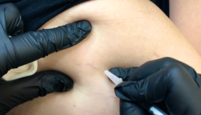 From Spiders to Airplanes: Sclerotherapy Questions Answered