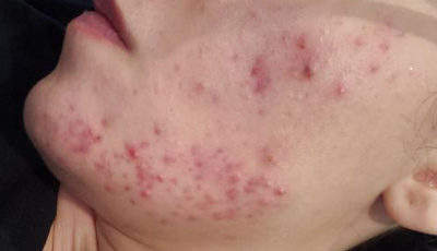 Anatomy of Acne