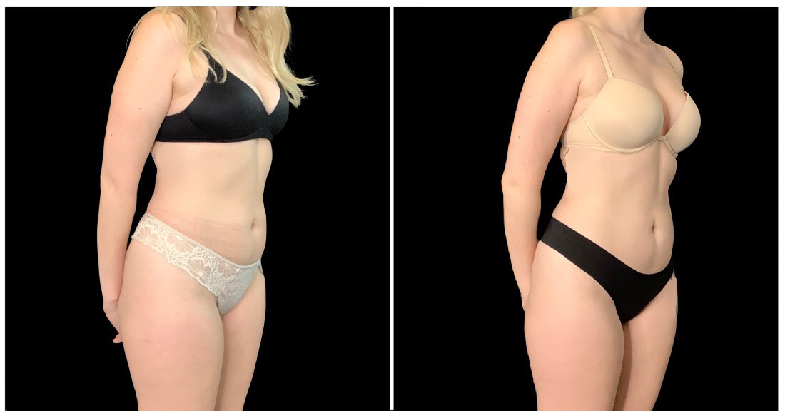EMSCULPT® in London Ontario before and after result
