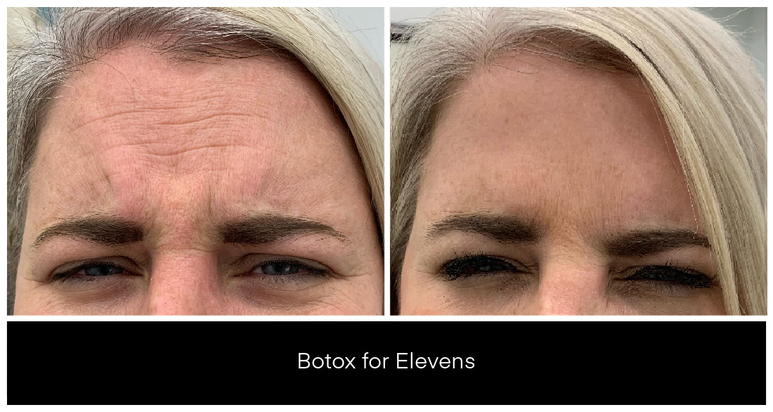 BOTOX® and Dysport® Treatments in London Ontario before and after result