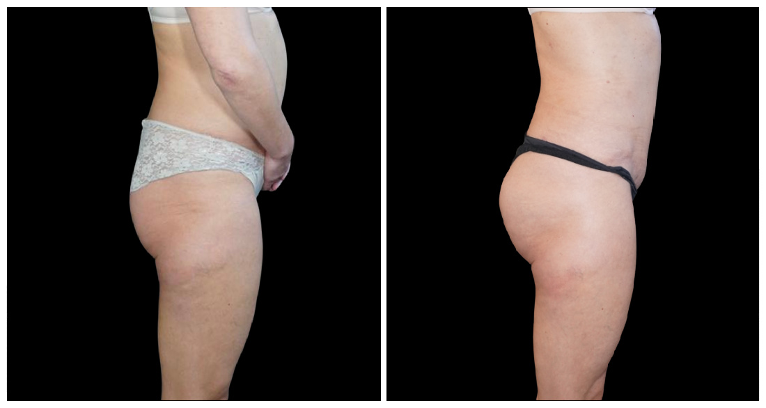 Brazilian Butt Lift before and after result
