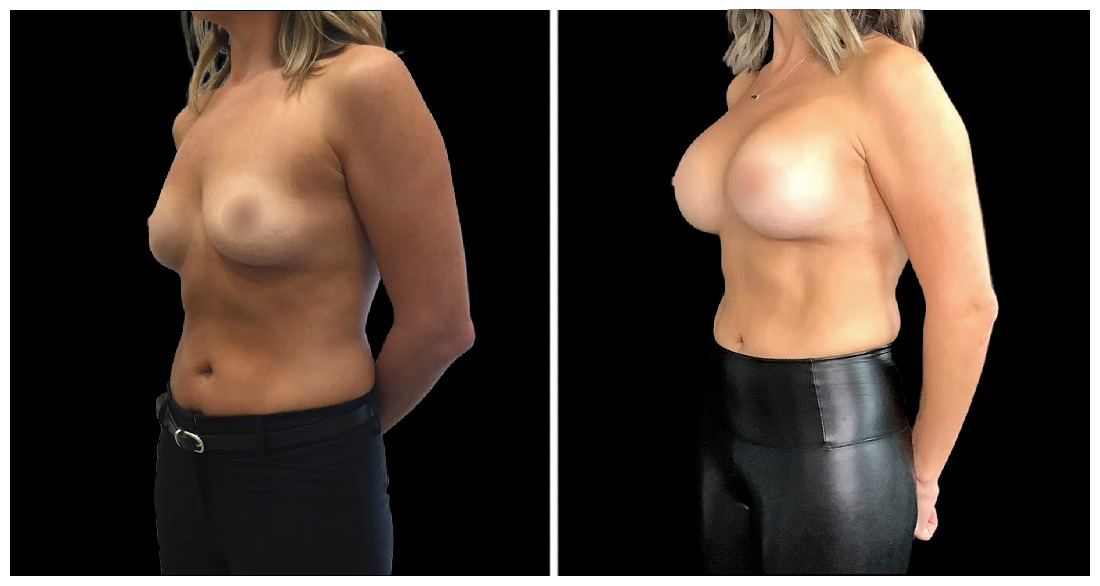 Breast Augmentation in London Ontario before and after result