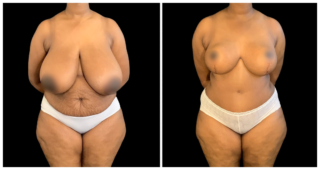 Breast Reduction before and after result