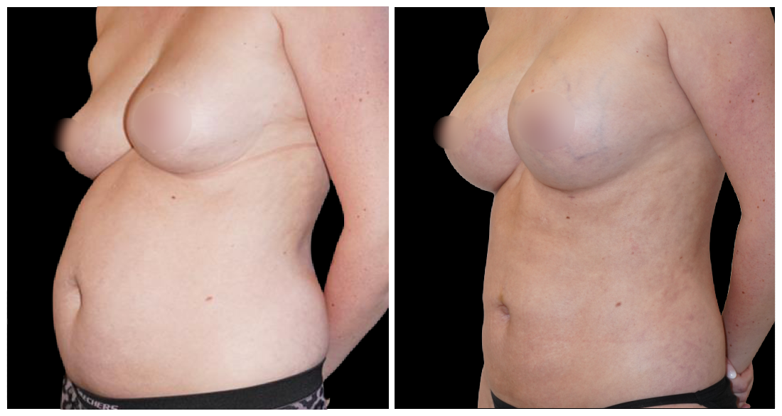 Fat Transfer to Breast before and after result