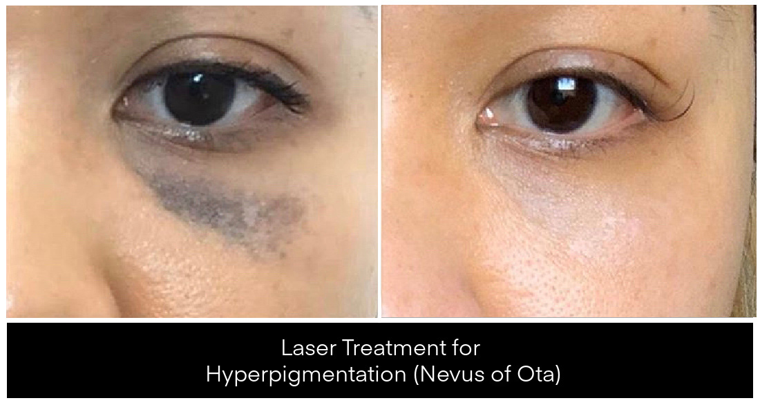 Laser Treatments for Pigmentation before and after result