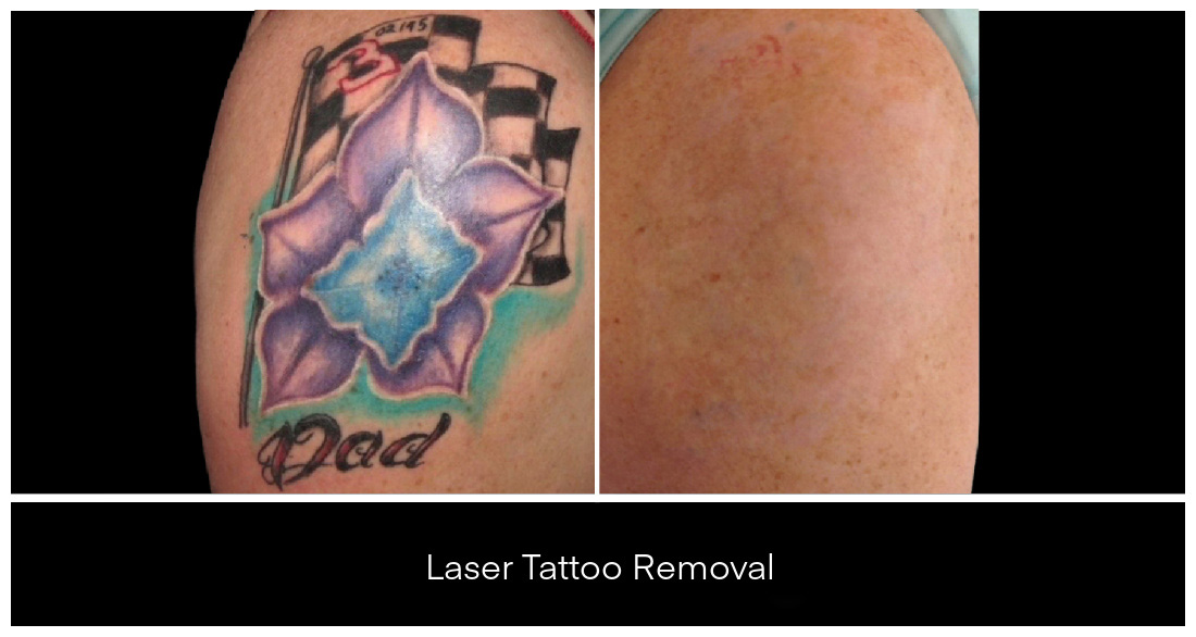 Laser Tattoo Removal in London Ontario before and after result