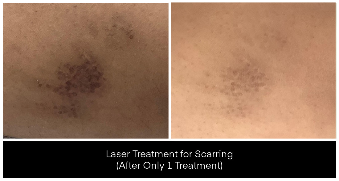 A before-and-after view shows scar reduction from laser treatments for scarring at Yazdani Aesthetics, with improvement after only one treatment.