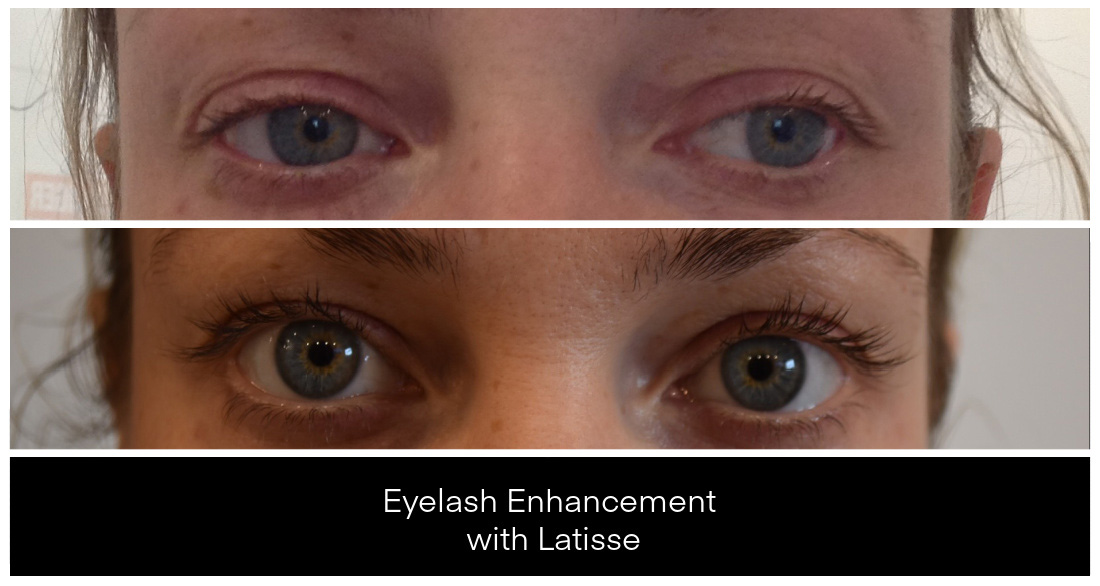 Eyelash Enhancement with LATISSE® before and after result
