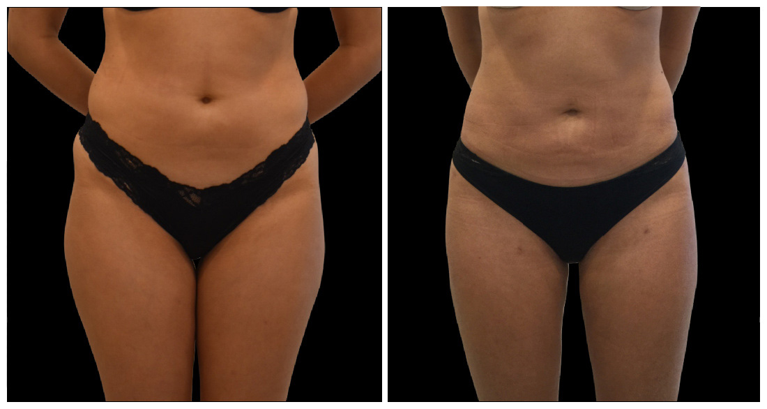 Before and after images of a liposuction procedure showing changes in abdominal contour and skin appearance.