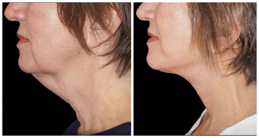 Before and after neck lift at Yazdani Aesthetics in London Ontario, showing a smoother jawline and tightened neck skin with a light complexion and brown hair.