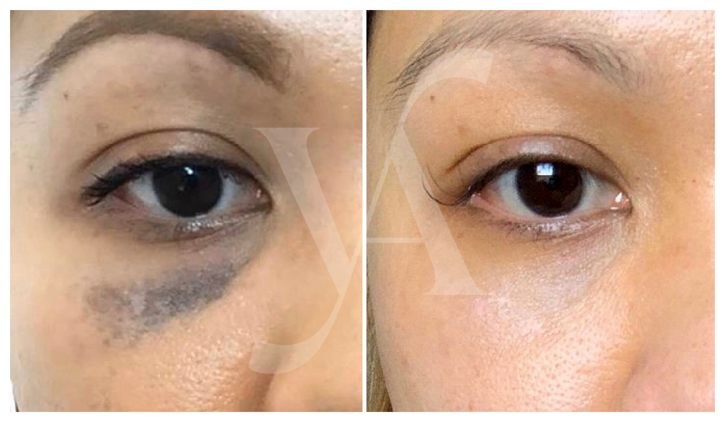 Tricky Pigment and Laser Treatment