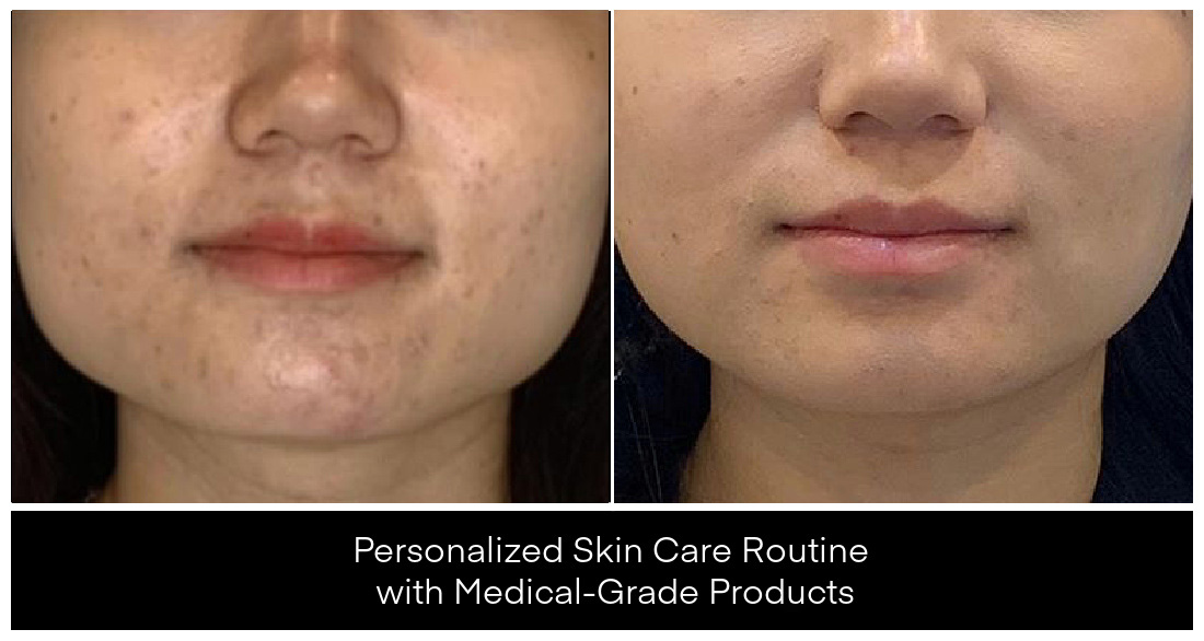 At-Home Skin Care before and after result