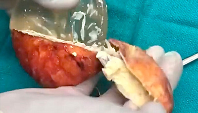 What is Capsular Contracture?