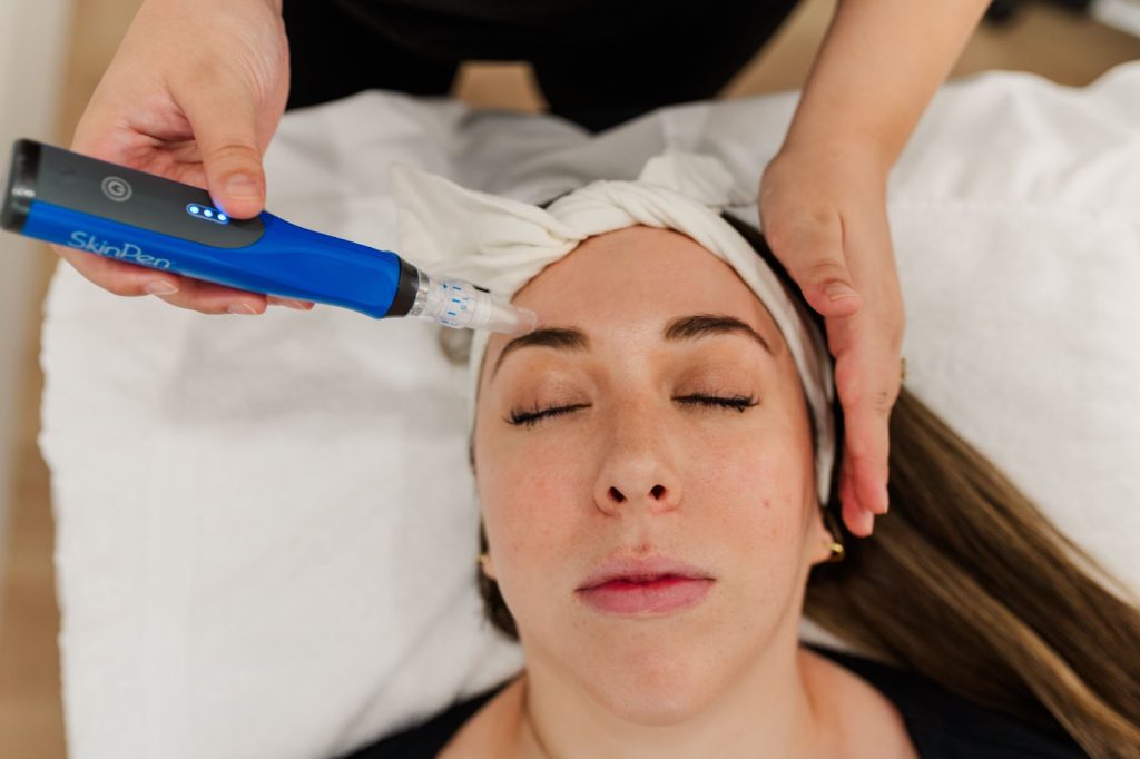 How Long Does Microneedling Last?