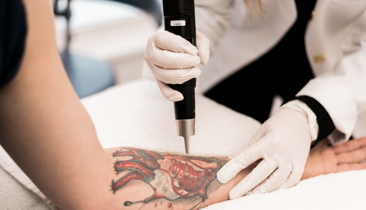 Does laser tattoo removal leave scars?