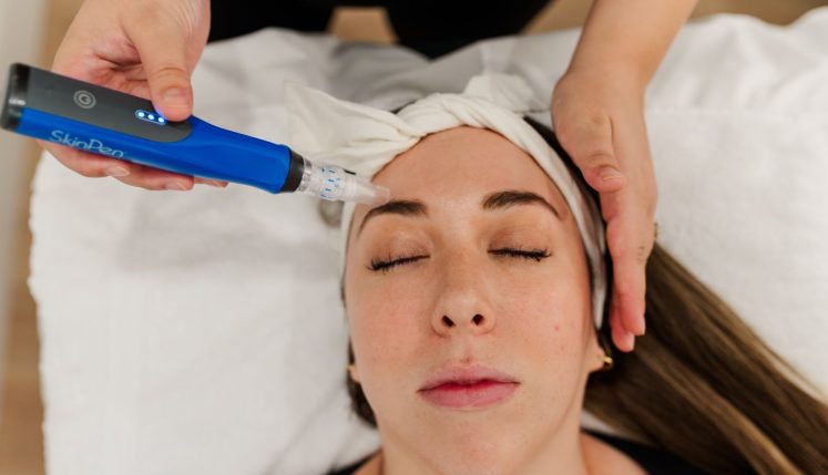 microneedling at Yazdani Aesthetics